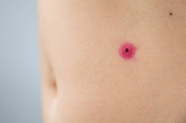 Bir kadının karnındaki siğili yakın plan. Yandıktan sonra insan papillomavirüsü