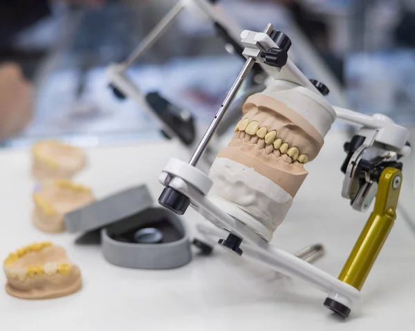 stock image Plaster cast of the jaw in the articulator in the prosthetic workshop