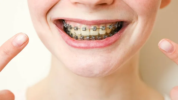 Close Portrait Young Woman Pointing Smile Braces Her Teeth — 스톡 사진
