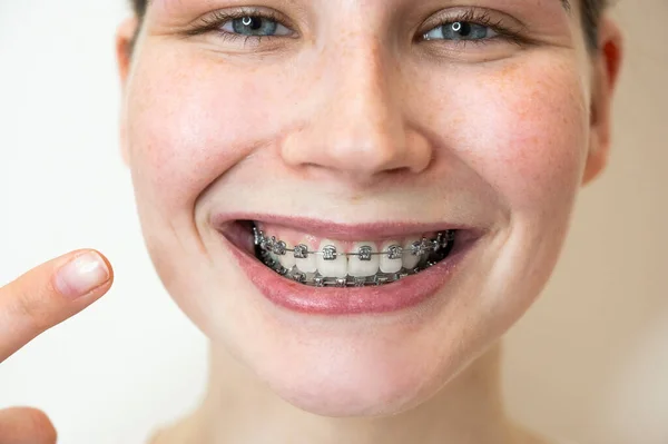 Крупним Планом Портрет Молодої Жінки Вказує Посмішку Брекетами Зубах — стокове фото