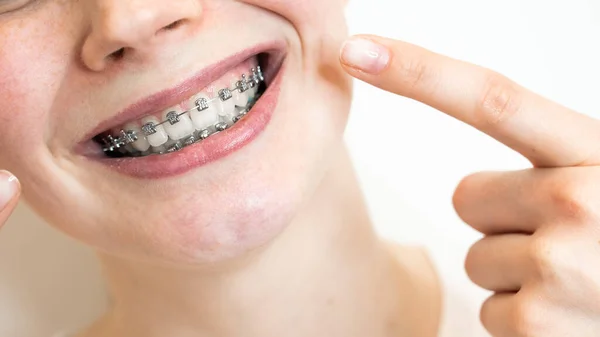 Close Portrait Young Woman Pointing Smile Braces Her Teeth — Stock Photo, Image