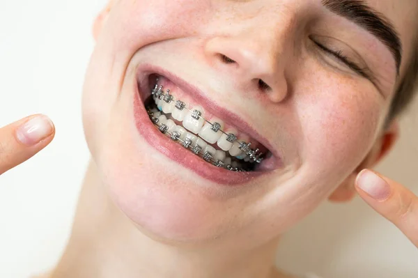 Close Portrait Young Woman Pointing Smile Braces Her Teeth — 스톡 사진