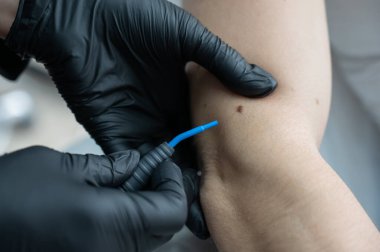 Dermatolog, elektrokoagülatör kullanarak hastanın kolundaki bir beni çıkarıyor.