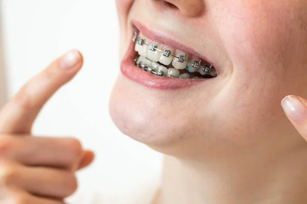 Close Portrait Young Woman Pointing Smile Braces Her Teeth — Stock Photo, Image
