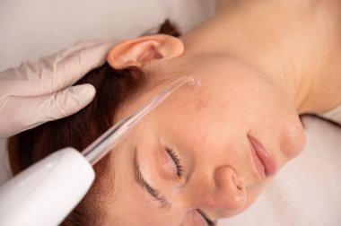 Doktor, kadın bir hastanın yüzündeki sivilce için darsonval aparatı kullanıyor.