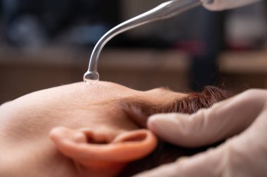 Doktor, kadın bir hastanın yüzündeki sivilce için darsonval aparatı kullanıyor.