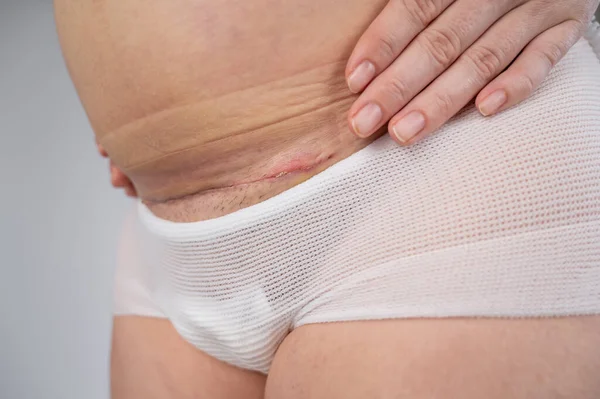 一个女人在剖腹产时露出一道新的伤疤 — 图库照片