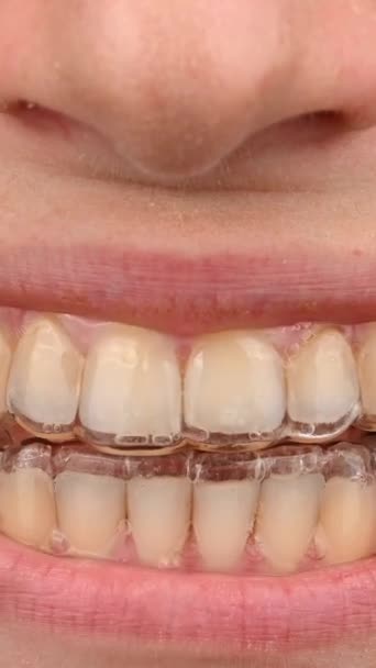 Caucasian woman smiling wearing a removable retainer. Vertical video