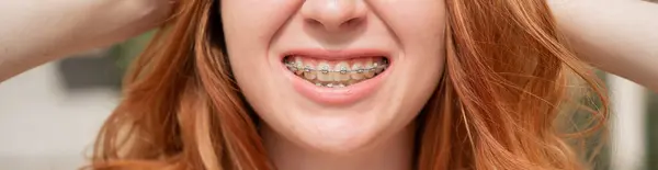 Close-up portrait of a young red-haired woman with braces on her teeth. Girl makes faces at the camera outdoors. Widescreen