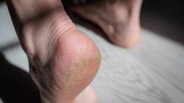 Çatlamış tabanlı bir kadının ayaklarının yakın çekimi.
