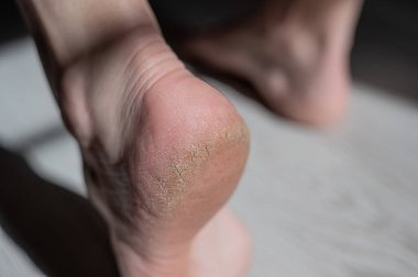 Çatlamış tabanlı bir kadının ayaklarının yakın çekimi.