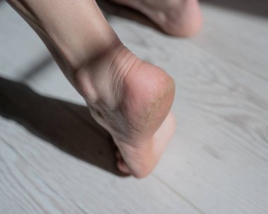 Çatlamış tabanlı bir kadının ayaklarının yakın çekimi.