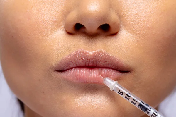 亚洲妇女注射胶原蛋白填充物时嘴唇的闭合 女性气质 面部表情 抗衰老 皮肤和美容疗法 — 图库照片