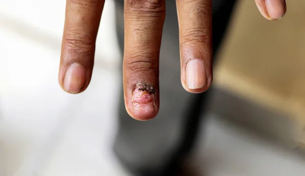 Інфекція Грибка Нігтях Рука Палець Оніхомікозом Який Фокус — стокове фото