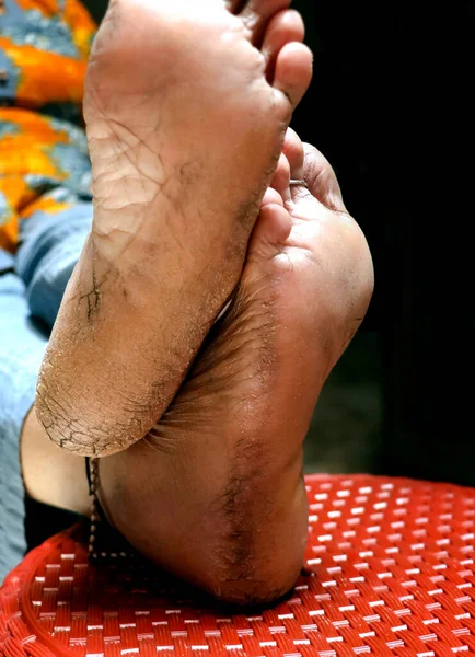 Gros Plan Des Talons Sales Fissurés Une Indienne Concentration Sélective — Photo