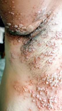 Teninde iltihap (herpes zoster) hastalığı olan kadınları yakından görmek onu çok üzüyor. cilt uçuk ilacı, virüs, sağlık ve tıbbi bakım ile enfekte olmuş..