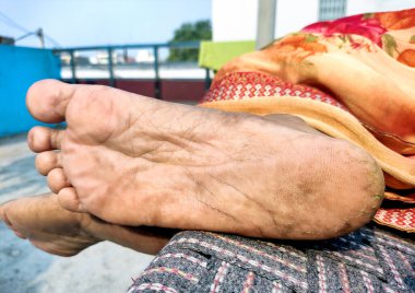 Kırk yaşında Hintli bir kadının derisi kırıktı. Topuk çatlakları olarak da bilinen çatlak topuklar, rahatsızlık hatta ağrıya neden olabilecek yaygın bir ayak rahatsızlığıdır. Kuru deriden kaynaklanırlar. Seçici Odaklanma