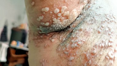 Teninde iltihap (herpes zoster) hastalığı olan kadınları yakından görmek onu çok üzüyor. cilt uçuk ilacı, virüs, sağlık ve tıbbi bakım ile enfekte olmuş..