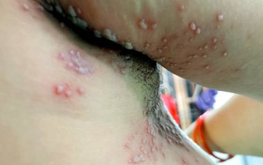 Teninde iltihap (herpes zoster) hastalığı olan kadınları yakından görmek onu çok üzüyor. cilt uçuk ilacı, virüs, sağlık ve tıbbi bakım ile enfekte olmuş..