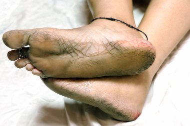 Yüksek çözünürlüklü yakın çekim görüntüsü kuru, çatlak topuklar ve çıplak ayak tabanları, cilt dokusu ve ayak bakımı sorunları vurgulanıyor.