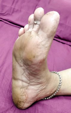 Yüksek çözünürlüklü yakın çekim görüntüsü kuru, çatlak topuklar ve çıplak ayak tabanları, cilt dokusu ve ayak bakımı sorunları vurgulanıyor.