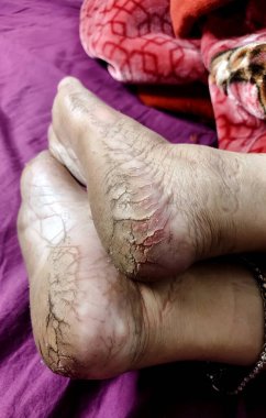 Yüksek çözünürlüklü yakın çekim görüntüsü kuru, çatlak topuklar ve çıplak ayak tabanları, cilt dokusu ve ayak bakımı sorunları vurgulanıyor.