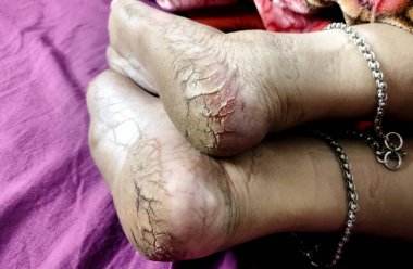 Yüksek çözünürlüklü yakın çekim görüntüsü kuru, çatlak topuklar ve çıplak ayak tabanları, cilt dokusu ve ayak bakımı sorunları vurgulanıyor.