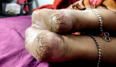 Yüksek çözünürlüklü yakın çekim görüntüsü kuru, çatlak topuklar ve çıplak ayak tabanları, cilt dokusu ve ayak bakımı sorunları vurgulanıyor.