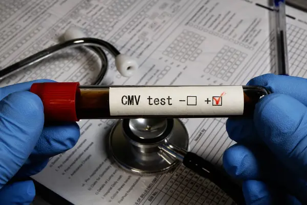 Eldivenli ellerden alınan kan örneği, arka planda stetoskop ve tıbbi form bulunan CMV testi için pozitif sonuç veriyor.