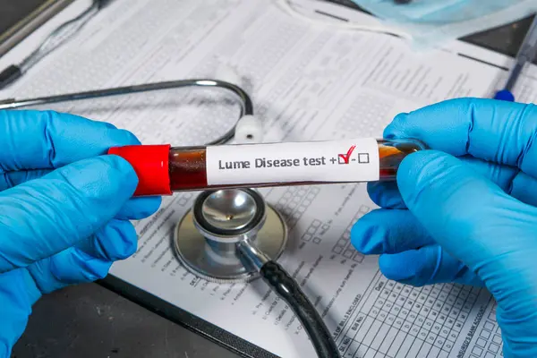 Tıbbi formlar ve steteskop üzerinde pozitif Lyme hastalığı örneği bulunan bir test tüpü tutan eldivenli eller.