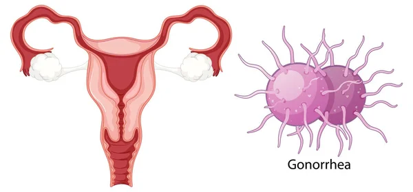 Infección Vaginal Bacterias Concepto Ilustración — Vector de stock