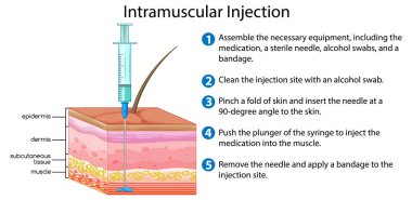 Intramuscular Injection with explanation illustration
