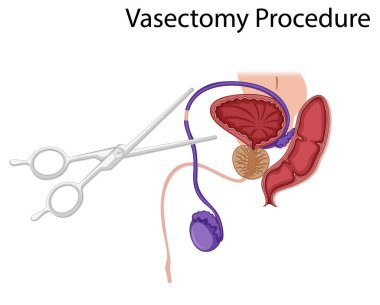 Diagram showing Vasectomy Procedure illustration