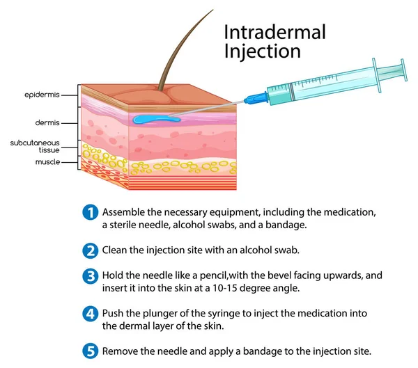 Intradermale Injectie Met Uitleg Illustratie — Stockvector