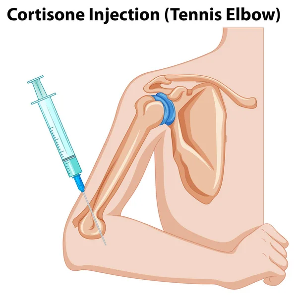 Cortisone Injection Tennis Elbow Diagram Illustration — Stock Vector