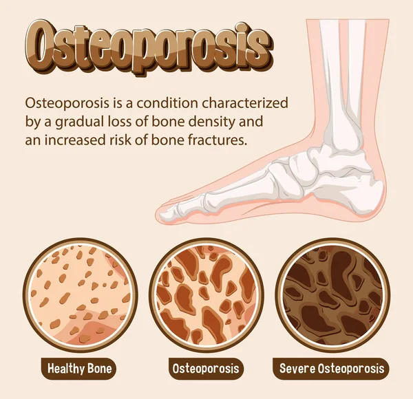 Cartaz Informativo Osteoporose Ilustração Óssea Humana —  Vetores de Stock