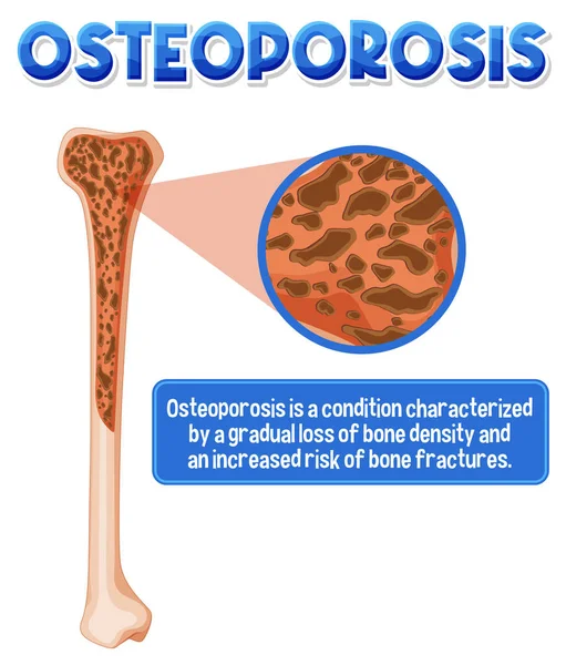 Informative Poster Osteoporosis Human Bone Illustration — Stock Vector