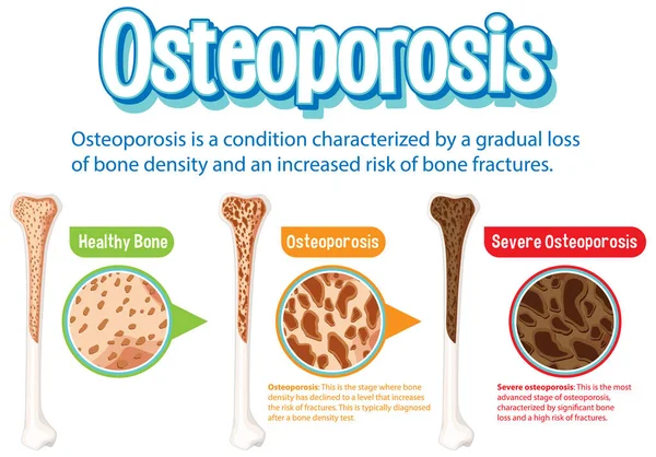 Cartaz Informativo Osteoporose Ilustração Óssea Humana — Vetor de Stock