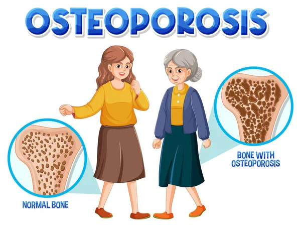 Comparação Osso Osso Normais Com Osteoporose Idosos Jovens Ilustração — Vetor de Stock