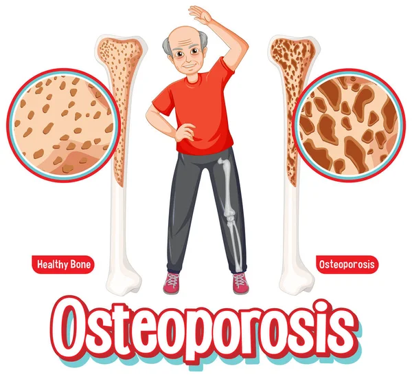 Comparação Osso Osso Normais Com Osteoporose Idosos Ilustração — Vetor de Stock