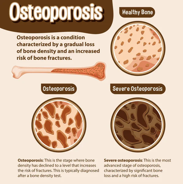 Informatieve Poster Van Osteoporose Illustratie Van Menselijke Botten — Stockvector