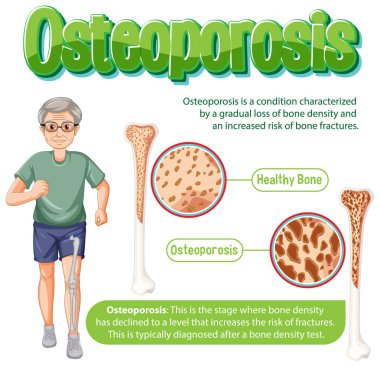 Informative poster of Osteoporosis human bone illustration clipart