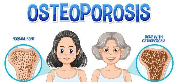 Comparison Normal Bone Bone Osteoporosis Old People Illustration — Stock Vector