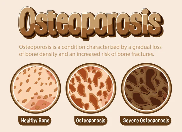 Informatieve Poster Van Osteoporose Illustratie Van Menselijke Botten — Stockvector