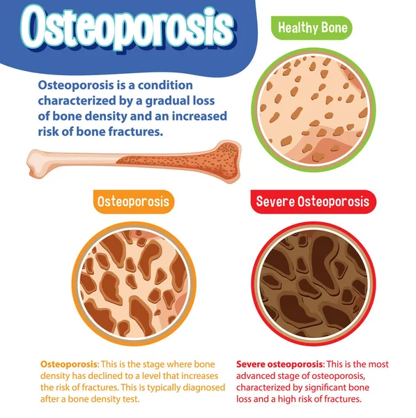 Informační Plakát Ilustrací Lidských Kostí Osteoporózou — Stockový vektor