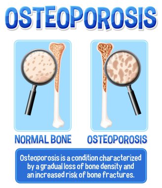 Osteoporoz insan kemik çiziminin bilgilendirici posteri