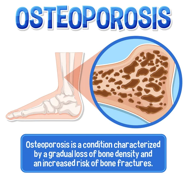 Osteoporoz Insan Kemik Çiziminin Bilgilendirici Posteri — Stok Vektör