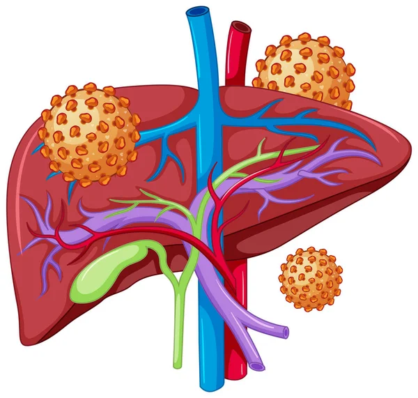 Ілюстрація Вірусу Гепатиту Печінки — стоковий вектор