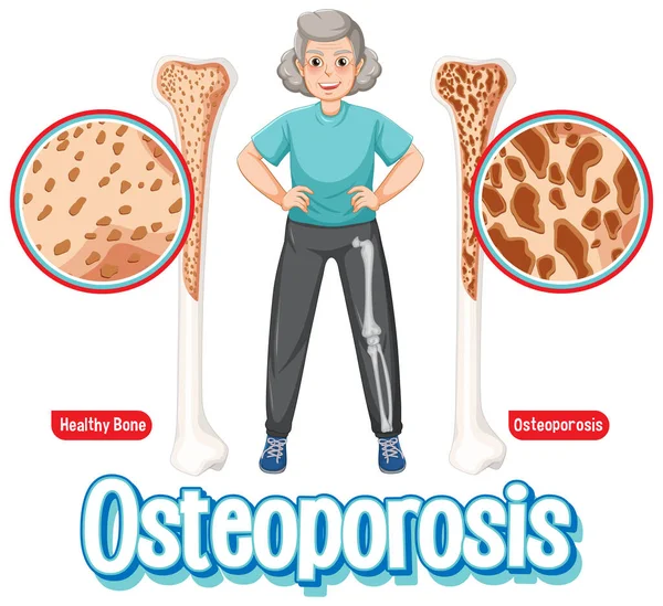 Vergleich Von Normalem Knochen Und Knochen Mit Osteoporose Bei Alten — Stockvektor
