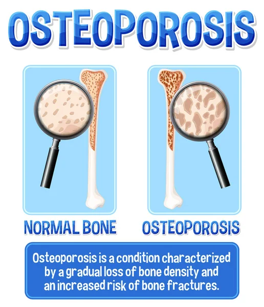 Cartaz Informativo Osteoporose Ilustração Óssea Humana — Vetor de Stock